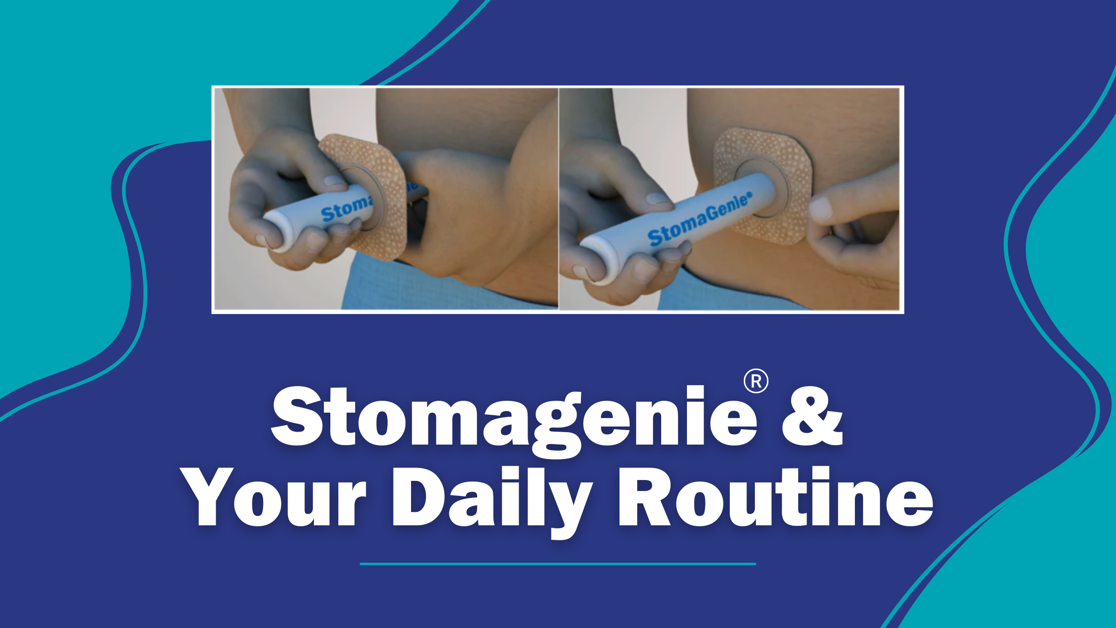 StomaGenie® and Your Daily Routine