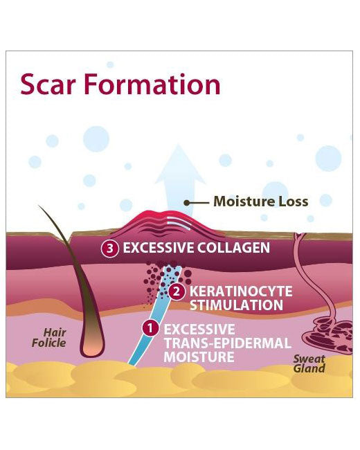 Biodermis Epi-Derm Silicone Gel Large Sheet 15.5"x11" - Clear Gel (5 Sheet per Package)