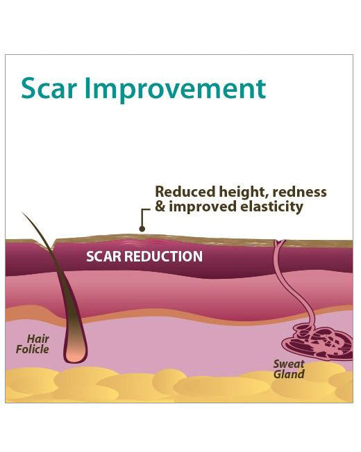 Biodermis Epi-Derm Silicone Gel Long Strip 1.4"x11.5" - Clear Gel (5 Pair per Package)