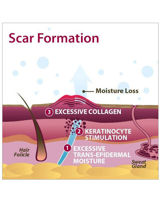Biodermis Epi-Derm Silicone Gel Patch 2"x2.5" - Clear Gel (1 Pair per Package)