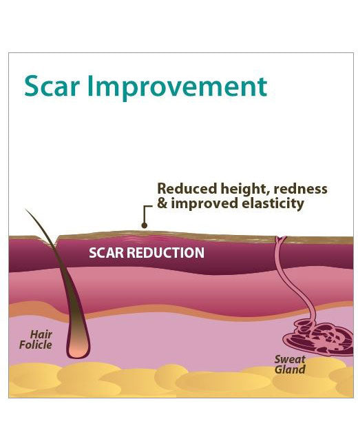 Biodermis Epi-Derm Silicone Gel Patch 2"x2.5" - Clear Gel (1 Pair per Package)