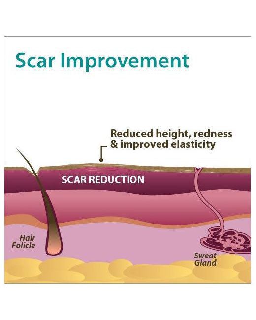 Biodermis Epi-Derm Silicone Gel Standard Sheet 4.7" x 5.7" - Clear Gel - 1 sheet per package