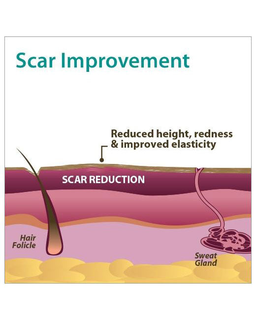 Biodermis Pro-Sil SPF  Silicone Scar Stick 4.25gm Tube - 1 each